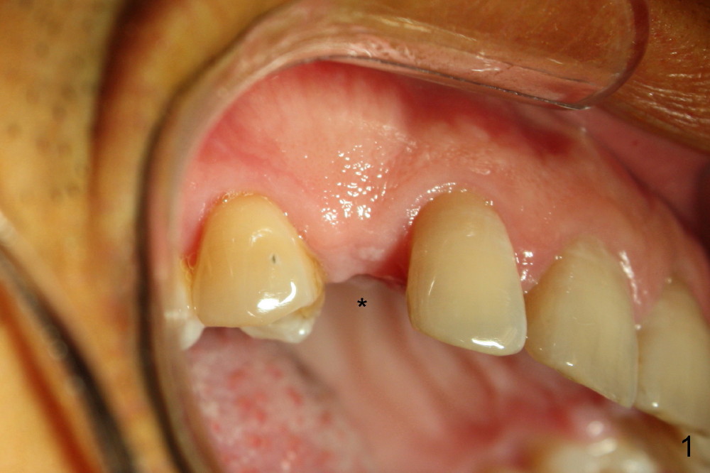 Immediate implant crown for congenitally missing canine, Dental